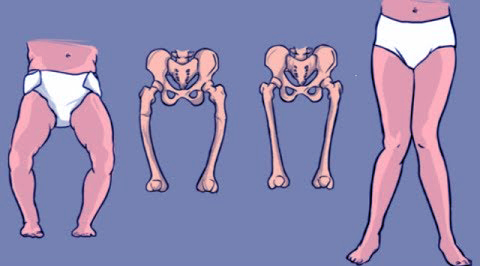 rickets